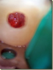 engorged pulp004