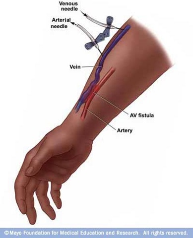 [Fistula%255B32%255D.jpg]