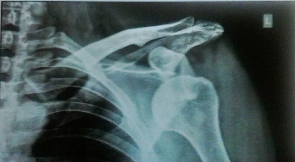 [dislocated-left-shoulder%255B3%255D.jpg]