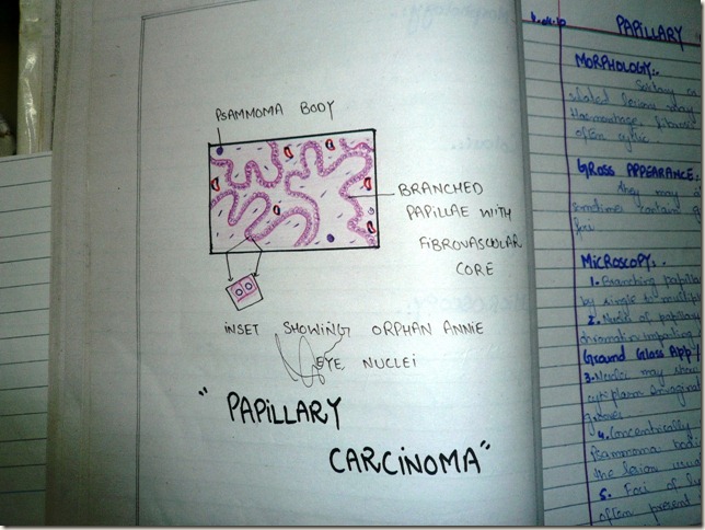papillary carcinoma thyroid handmade histopathology diagram
