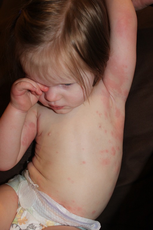 [2012-02-07%2520Hives%25203%255B4%255D.jpg]