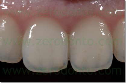 Fig. 140 trasparenza