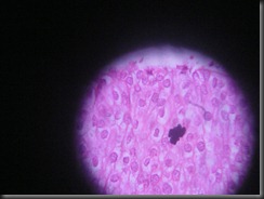 transitional cell CA high resolution histology slide tsnaps transitional cell CA high resolution histology slide tsnaps