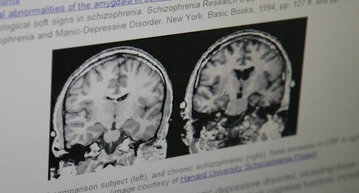 These images show how the ventricles of a person with Schizophrenia are enlarged. (Photo credit: Alex Crowder)