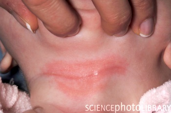 infant neck rash