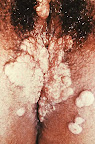 sifilis-vaginal.jpg