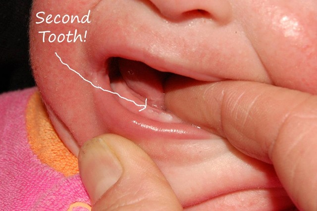 [tooth2%255B5%255D.jpg]