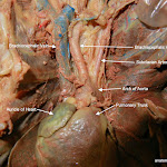 pulmonary_trunk_L.JPG