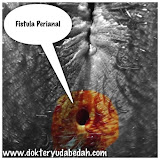 fistel perianal