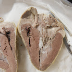 bicuspid_valve.JPG