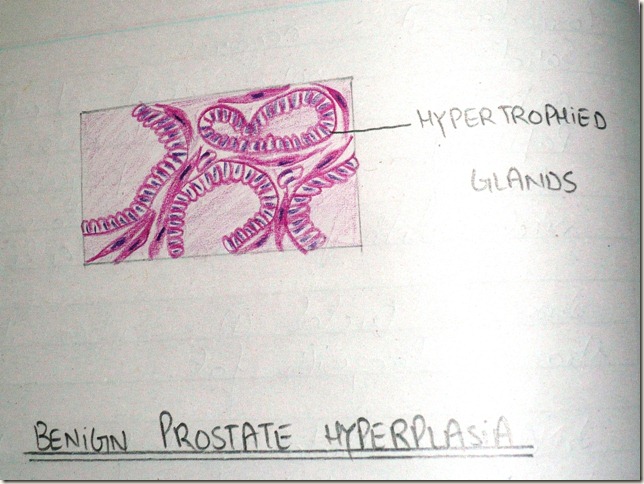 benign prostatic hyperplasia -BPH -hand made diagram histopathology