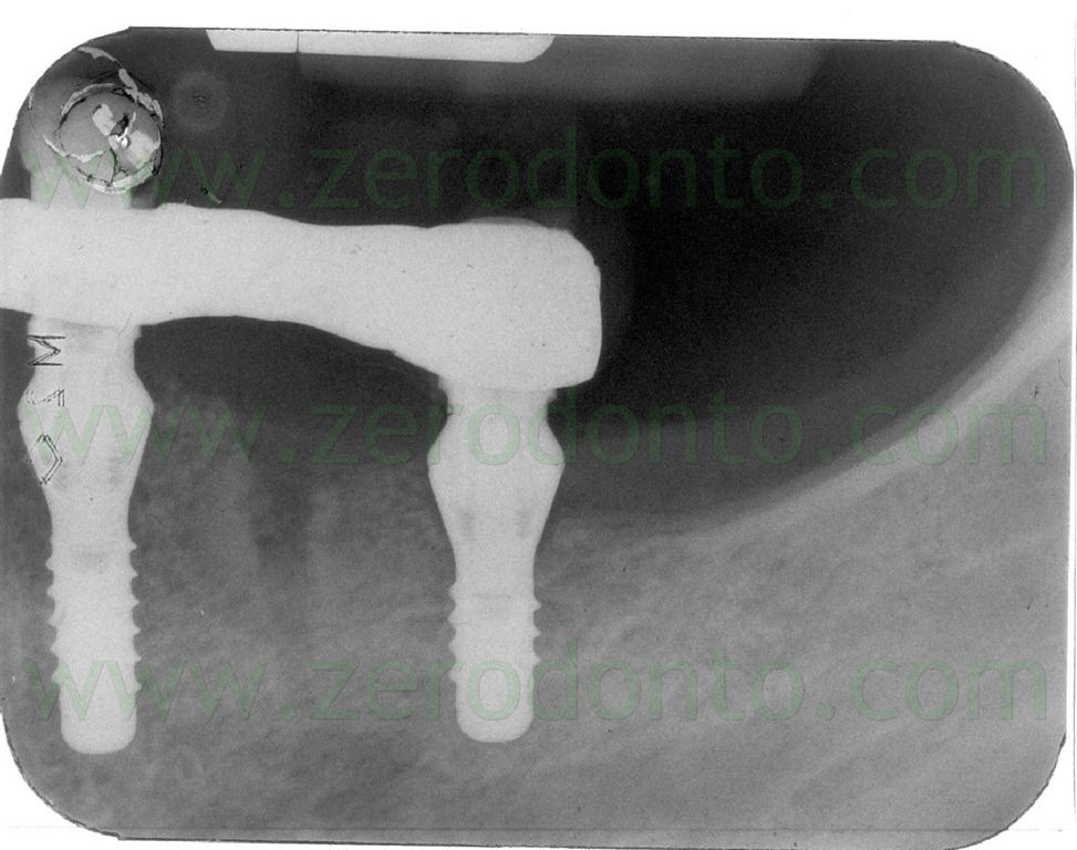 [--212-adattamento-passivo-protesi3.jpg]