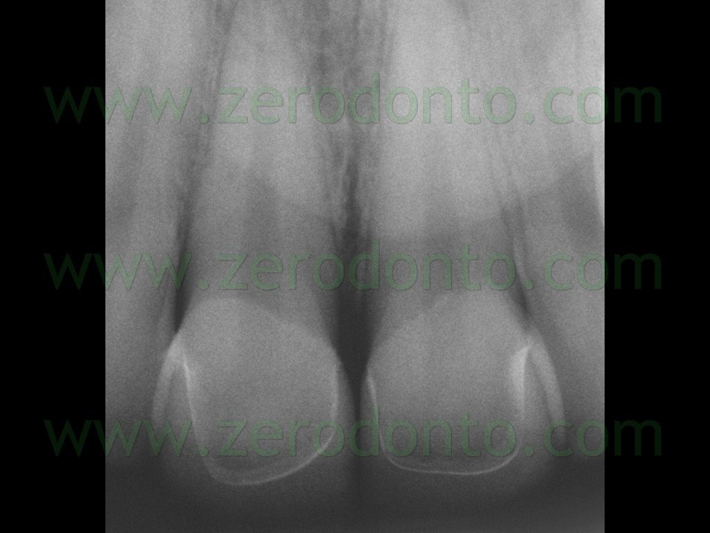 [122-radiografia-endorale-facette3.jpg]