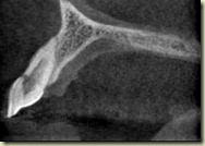 CT Buccal Resorption002