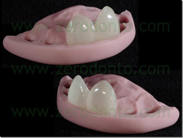 45 prova veneers