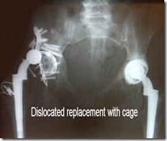 preop_dislocated_cage_-_AP_pelvis