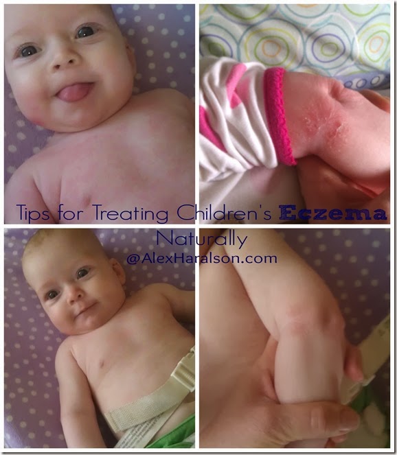 tips for treating children's eczema naturally
