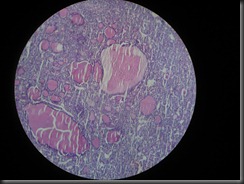 follicular adenoma thyroid high resolution histology slide tsnaps follicular adenoma thyroid high resolution histology slide tsnaps
