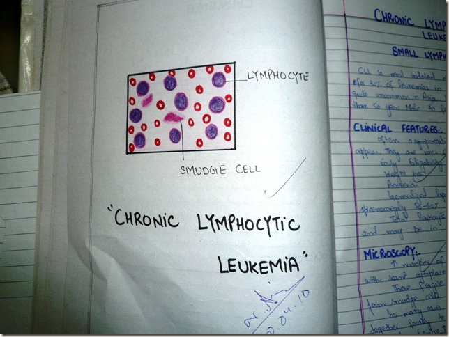 chronic lymphocytic leukemia -CLL-histopathology diagram