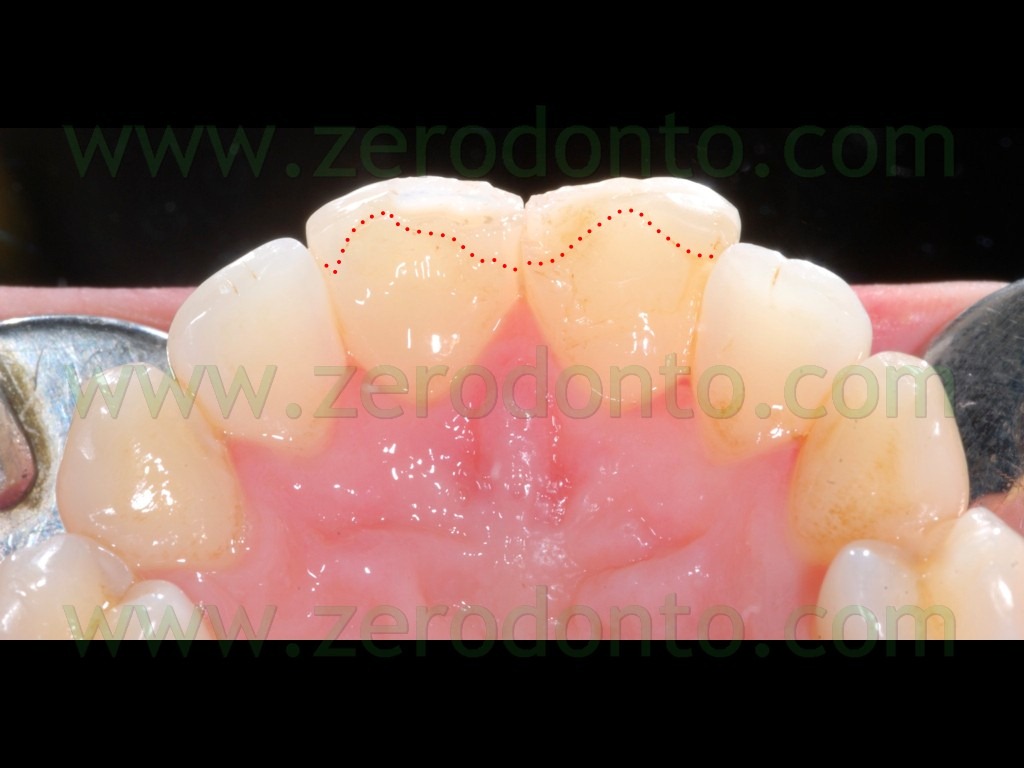 [7-frattura-denti7.jpg]