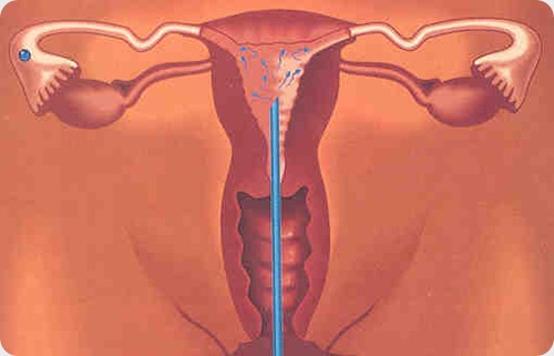 inseminacion artificial