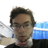 Fractured jaw