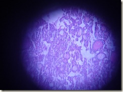 follicular adenoma thyroid histology slide photograph