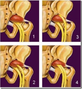 piriformis-279x300