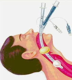 intubation