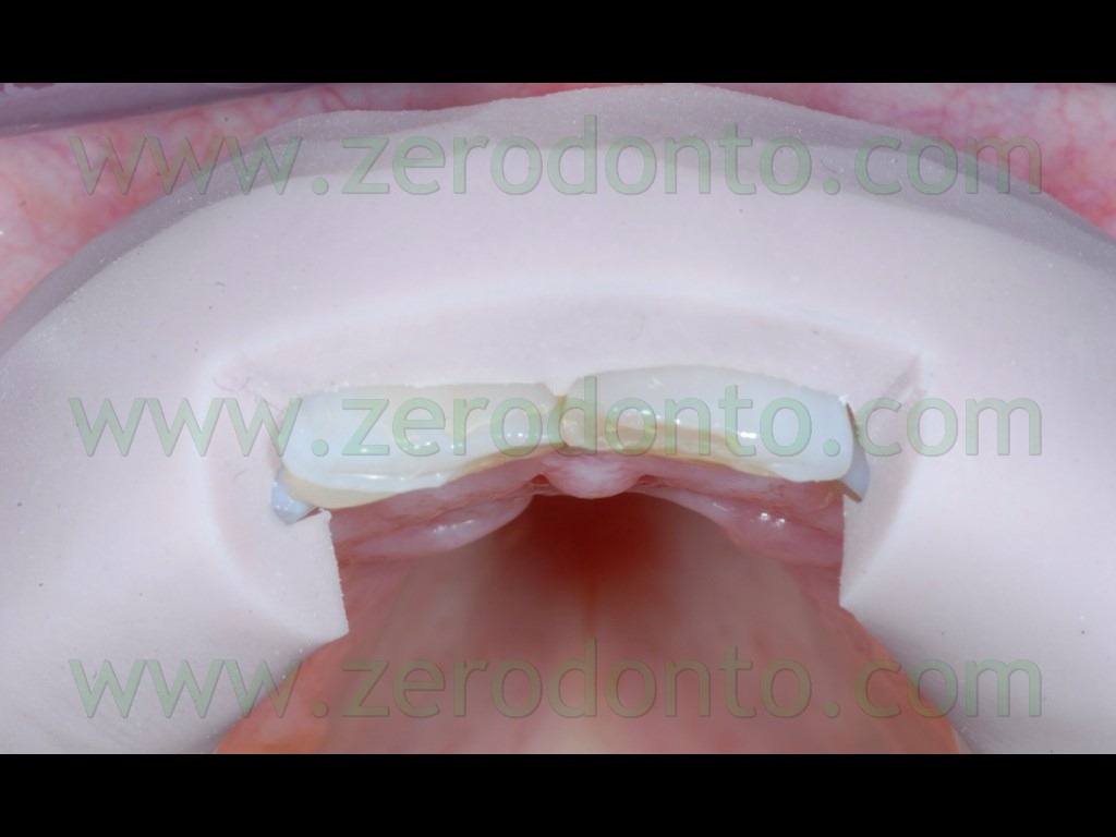 [52-preparazione-margine-incisale-fac%255B2%255D.jpg]
