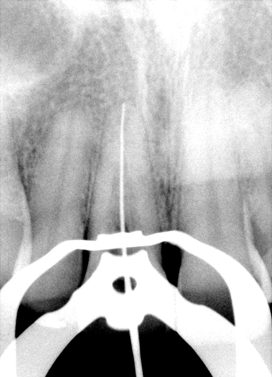 [Internal%2520Resorption%2520SB%2520file%2520shot011%255B3%255D.jpg]