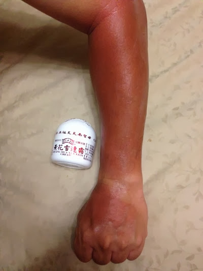 神奇药膏 Best Mosquito Cream Ever