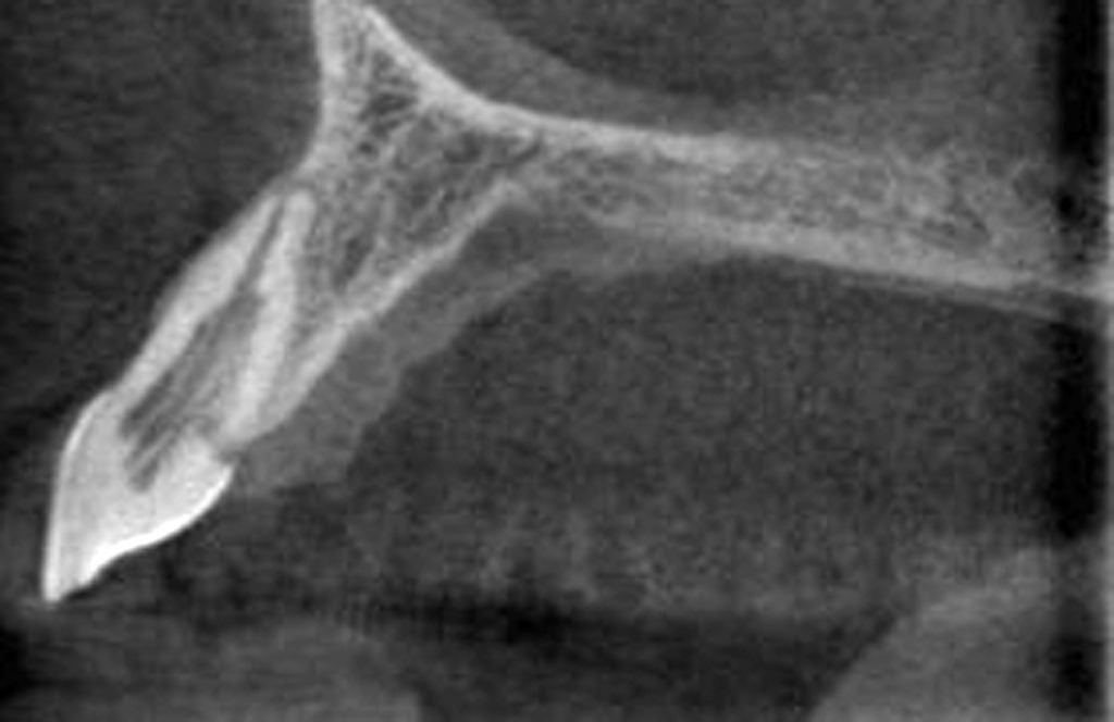 [CT%2520Palatal%2520Resorption003%255B4%255D.jpg]