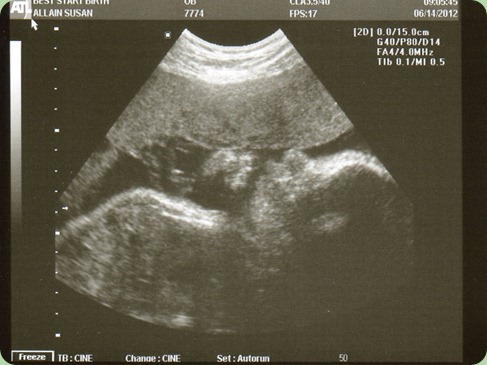 EMA ultrasound at 33 weeks