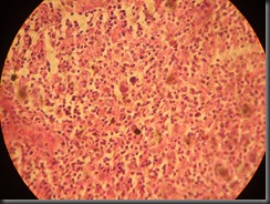 Hodgkin's Lymphoma high resolution histology slide tsnaps Hodgkin's Lymphoma high resolution histology slide tsnaps