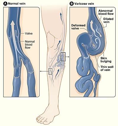 [Varicose_veins%255B2%255D.jpg]