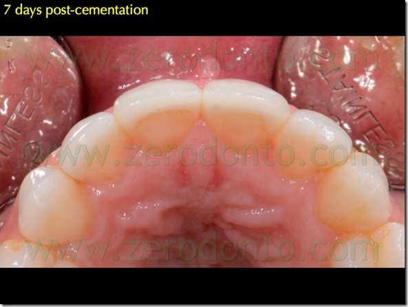 131 occlusione faccette chamfer palatal overlap