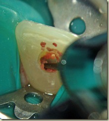 Removing pulp tissue019