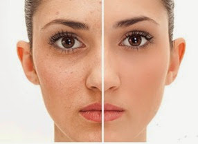 Tratamientos-Eliminar-Manchas-Cara Tratamientos-Eliminar-Manchas-Cara