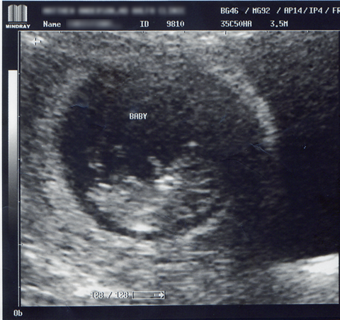 [baby%2520ultrasound%255B8%255D.png]