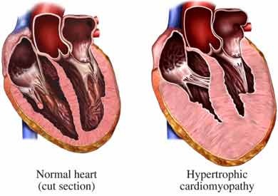 [cardiomiopatia%2520ipertrofica%255B2%255D.jpg]