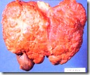 cirrhosis cirrhosis