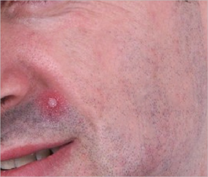 Area-after-acne