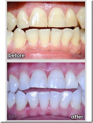 teeth whitening1