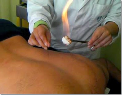 acupuntura curitiba agulha de fogo