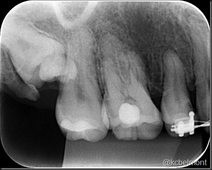 periapical supra 2 periapical supra 2