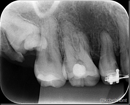 periapical supra 2