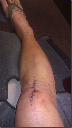 acl_post_op_stiches