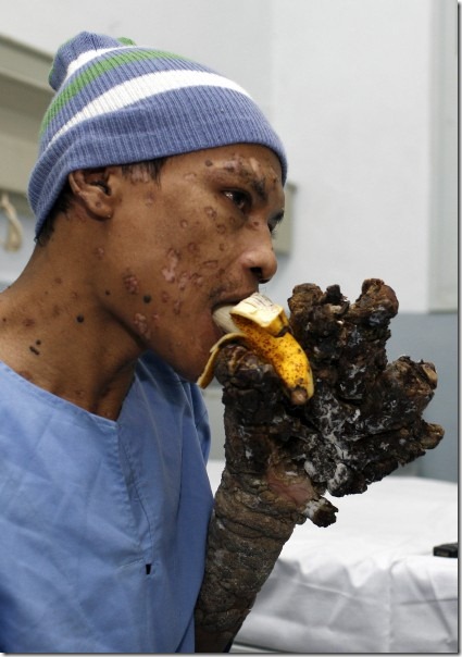 hombre arbol antes y despues (2)