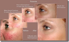 Causes-and-treatment-of-rosacea